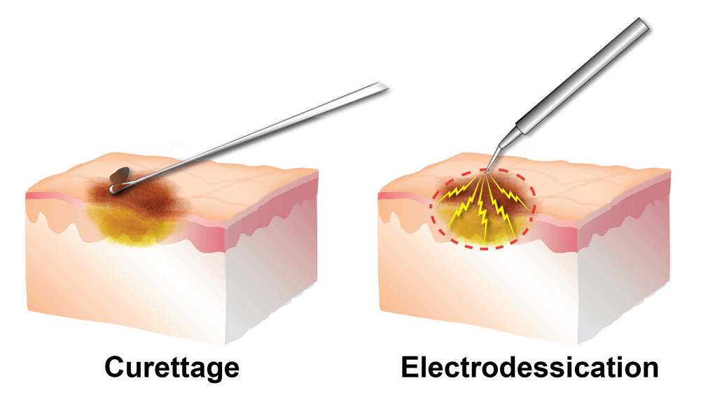 Surgical Dermatology in San Diego, CA Swati Kannan, MD